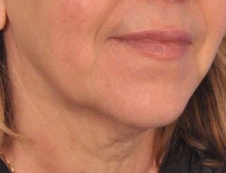 Lip Filler Before & After Gallery - Patient 237994 - Image 4