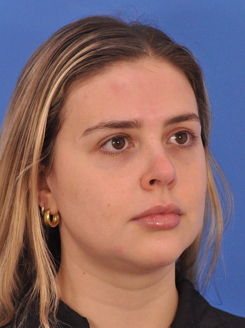 Chin Filler Before & After Gallery - Patient 170133 - Image 4