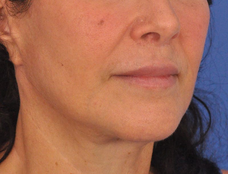 Lip Filler Before & After Gallery - Patient 216049 - Image 4