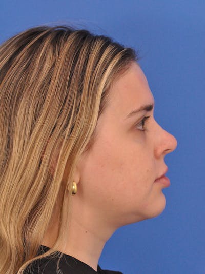 Chin Filler Before & After Gallery - Patient 170133 - Image 2