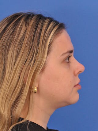 Chin Filler Before & After Gallery - Patient 170133 - Image 2
