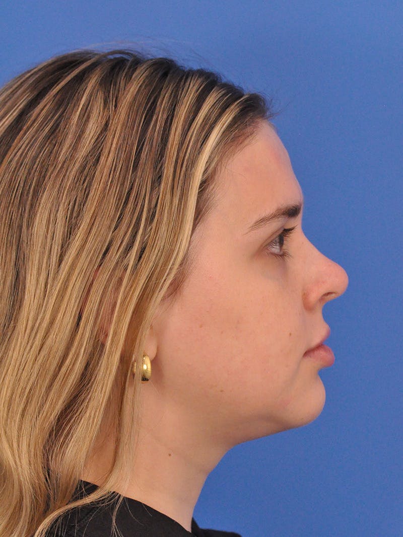 Chin Filler Before & After Gallery - Patient 170133 - Image 2