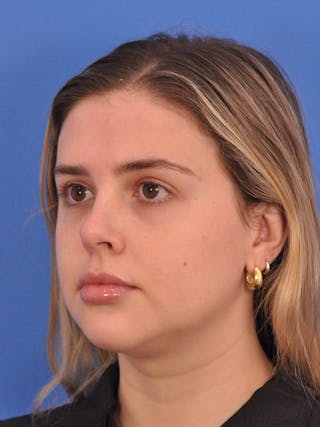 Chin Filler Before & After Gallery - Patient 170133 - Image 8