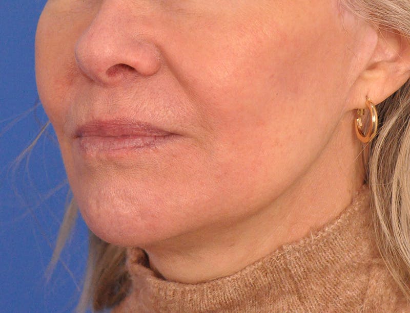 Lip Filler Before & After Gallery - Patient 325554 - Image 8