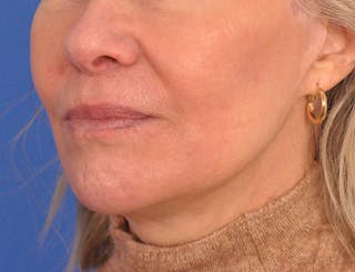 Lip Filler Before & After Gallery - Patient 325554 - Image 8