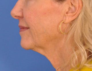 Profound Laser Before & After Gallery - Patient 312847 - Image 10