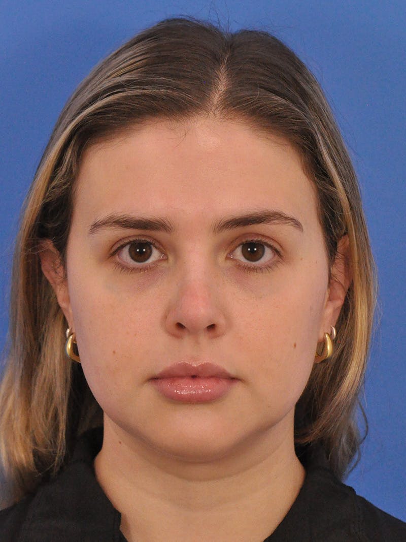 Chin Filler Before & After Gallery - Patient 170133 - Image 5