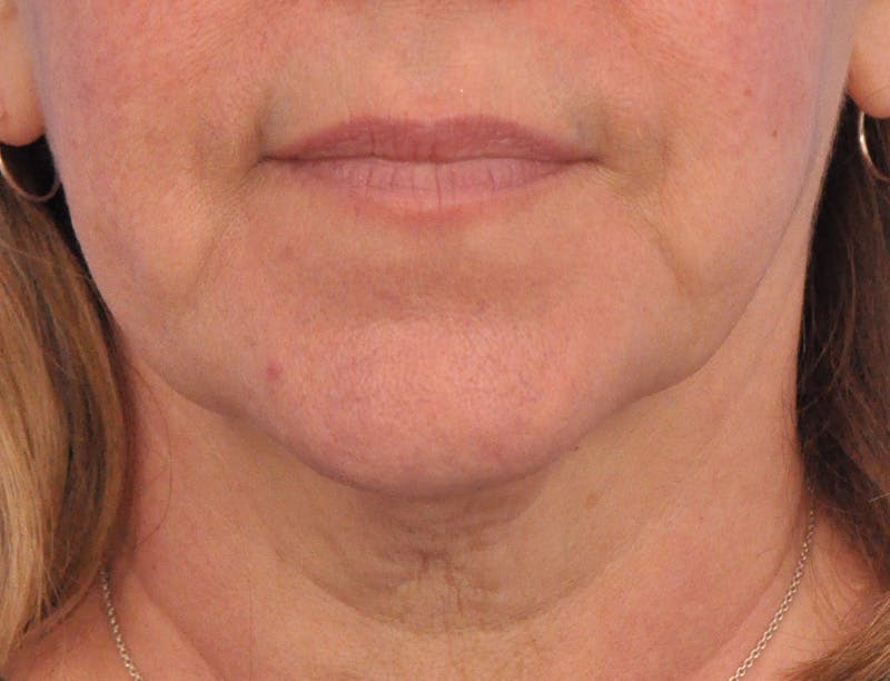 Lip Filler Before & After Gallery - Patient 237994 - Image 1