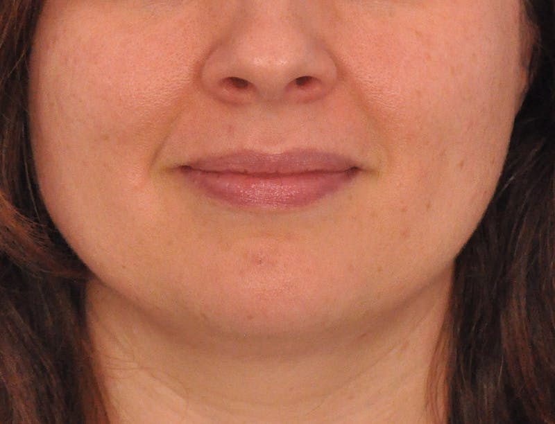 Lip Filler Before & After Gallery - Patient 296687 - Image 1