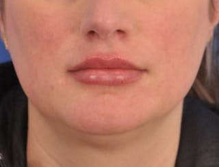 Lip Filler Before & After Gallery - Patient 310772 - Image 2