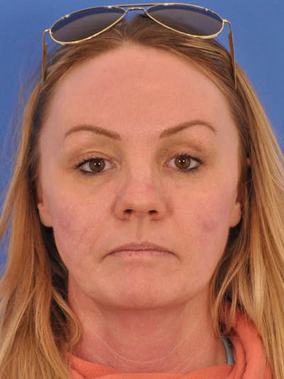 Acne Scars Before & After Gallery - Patient 147868 - Image 2