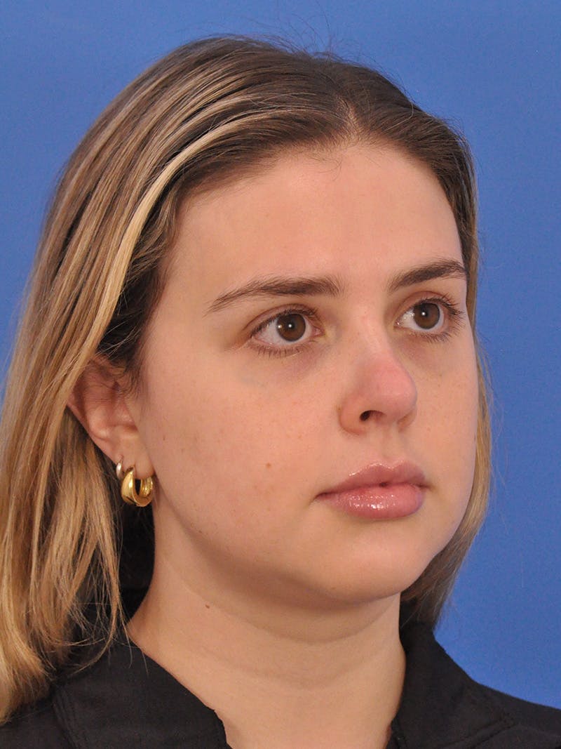 Chin Filler Before & After Gallery - Patient 170133 - Image 3