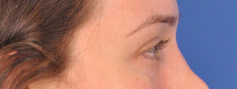 Tear Trough Filler Before & After Gallery - Patient 401813 - Image 6