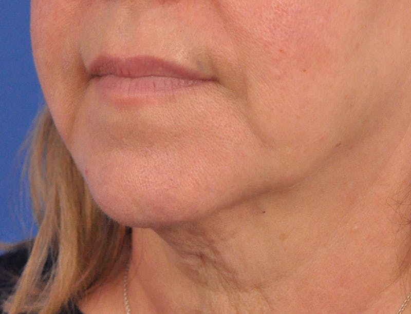 Lip Filler Before & After Gallery - Patient 237994 - Image 7