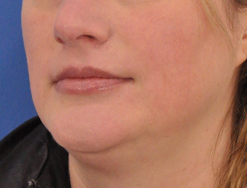 Lip Filler Before & After Gallery - Patient 310772 - Image 7