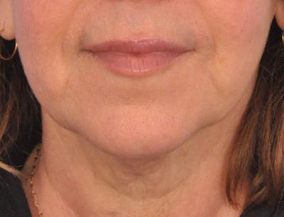 Lip Filler Before & After Gallery - Patient 237994 - Image 2