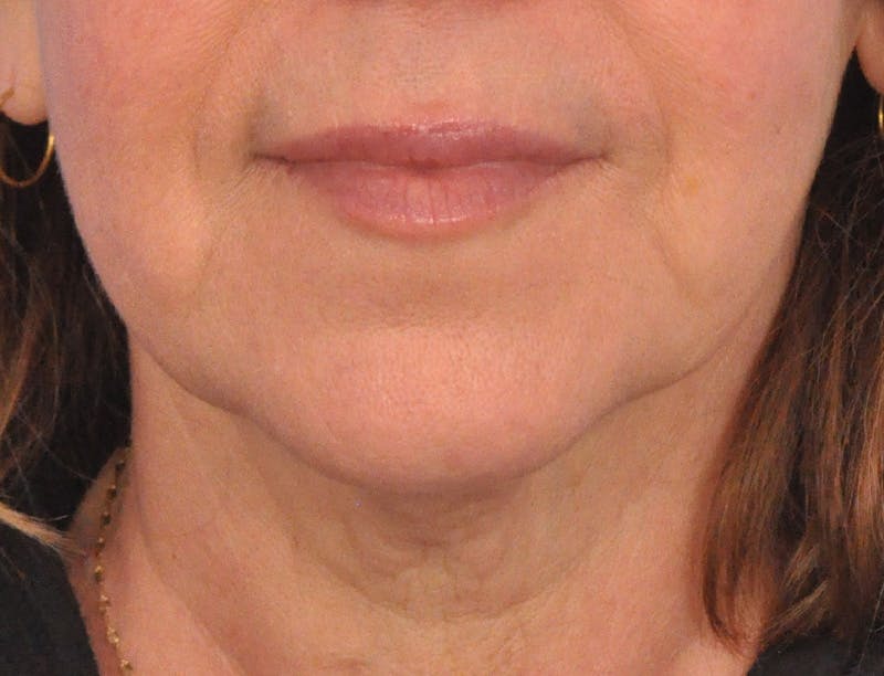 Lip Filler Before & After Gallery - Patient 237994 - Image 2