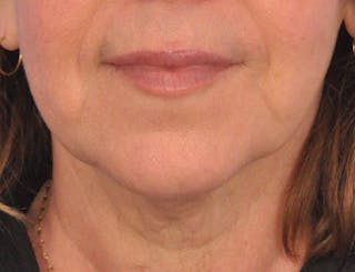 Lip Filler Before & After Gallery - Patient 237994 - Image 2