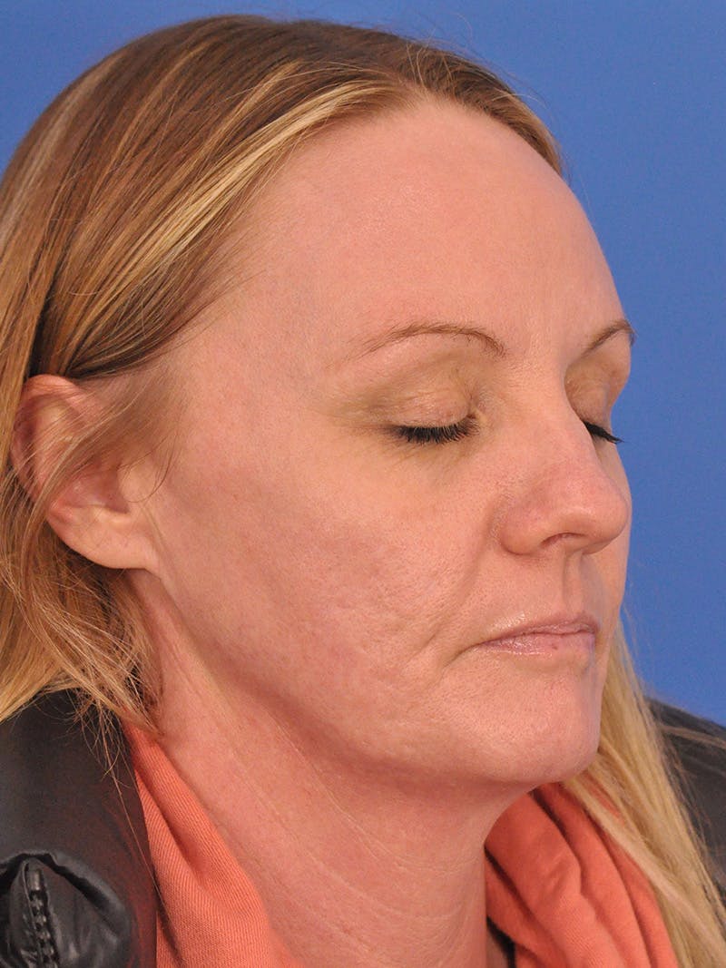 Acne Scars Before & After Gallery - Patient 147868 - Image 3