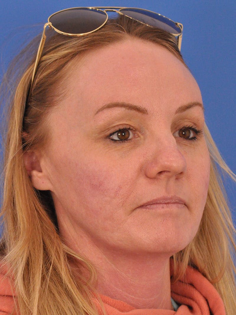 Acne Scars Before & After Gallery - Patient 147868 - Image 4