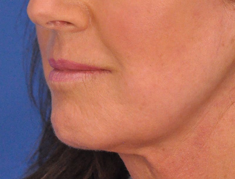 Lip Filler Before & After Gallery - Patient 947781 - Image 5