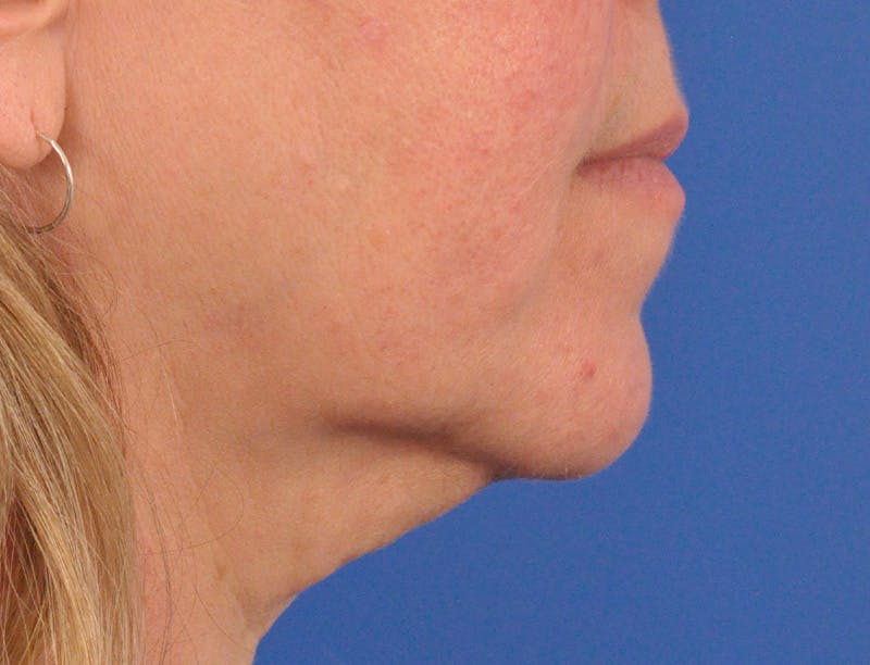 Lip Filler Before & After Gallery - Patient 237994 - Image 5