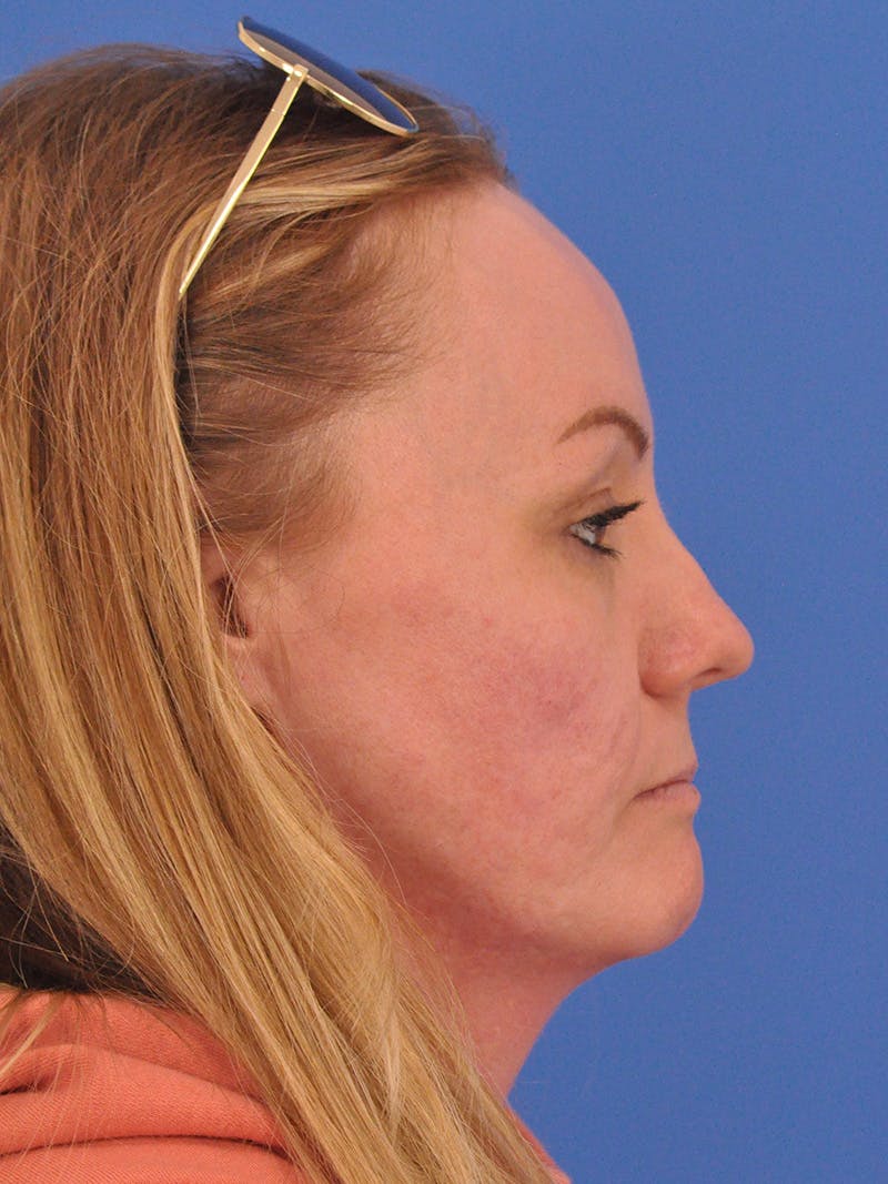 Acne Scars Before & After Gallery - Patient 147868 - Image 6