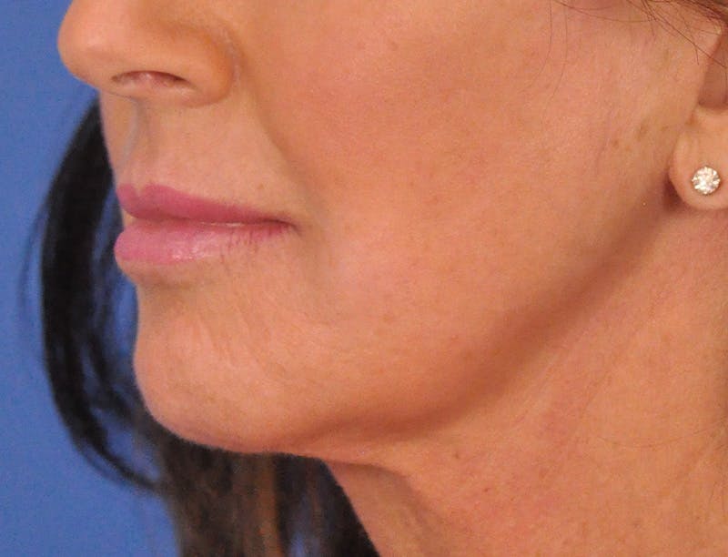 Lip Filler Before & After Gallery - Patient 947781 - Image 6