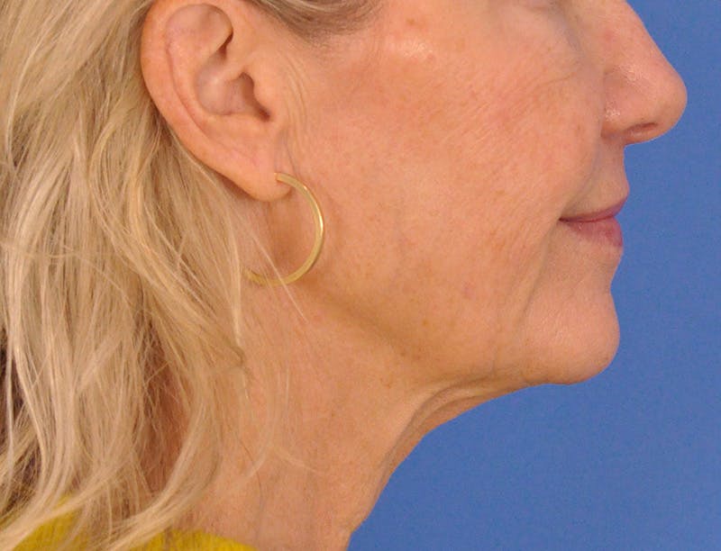 Profound Laser Before & After Gallery - Patient 312847 - Image 6