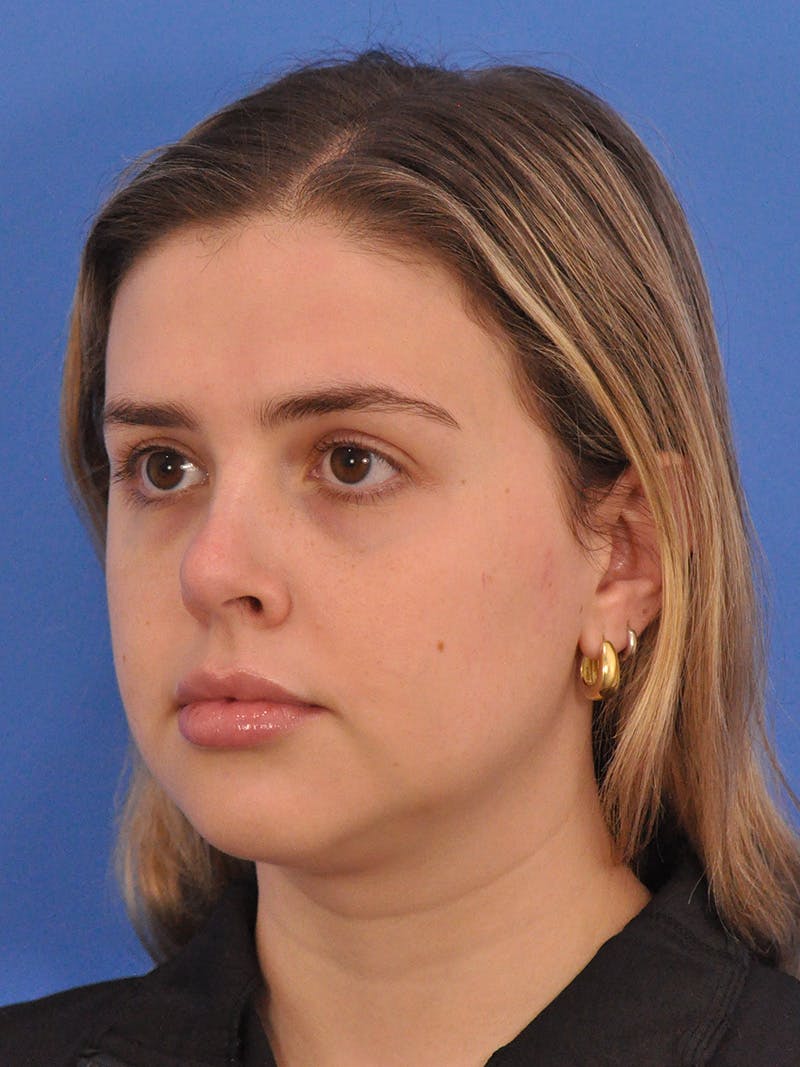 Chin Filler Before & After Gallery - Patient 170133 - Image 7