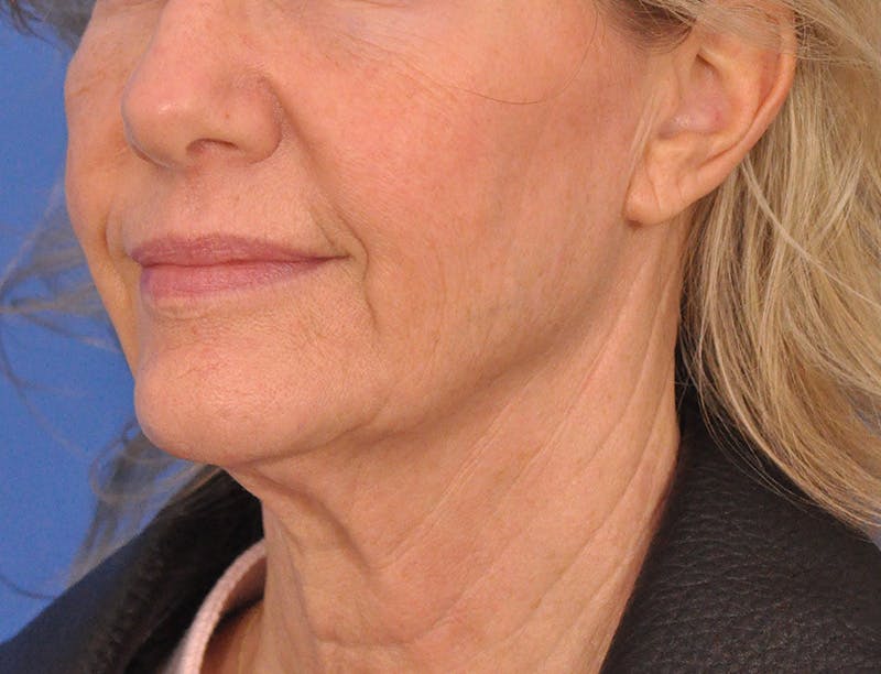 Profound Laser Before & After Gallery - Patient 312847 - Image 7