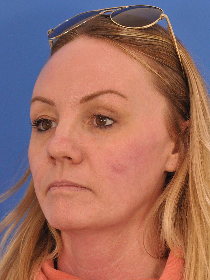 Acne Scars Before & After Gallery - Patient 147868 - Image 8