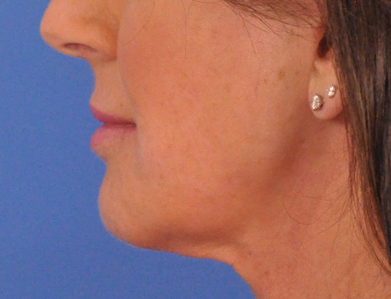Lip Filler Before & After Gallery - Patient 947781 - Image 8