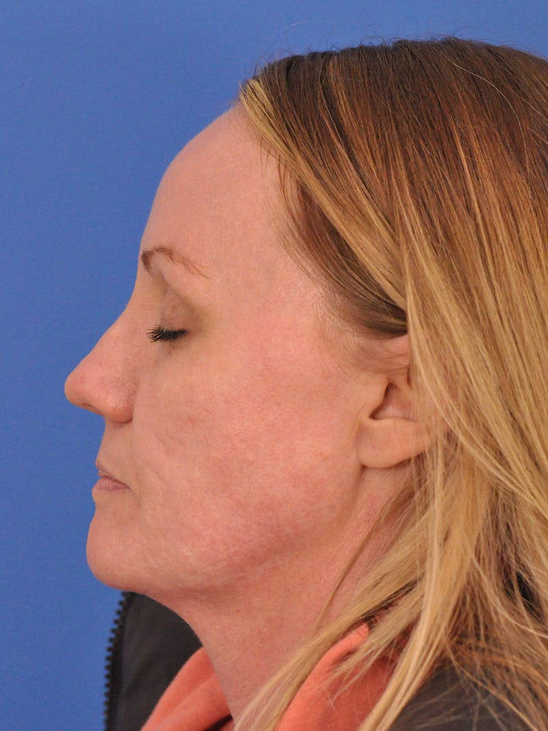 Acne Scars Before & After Gallery - Patient 147868 - Image 9