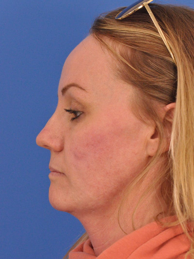Acne Scars Before & After Gallery - Patient 147868 - Image 10