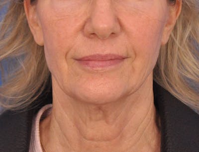 Profound Laser Before & After Gallery - Patient 312847 - Image 1