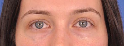 Tear Trough Filler Before & After Gallery - Patient 401813 - Image 2