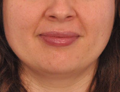 Lip Filler Before & After Gallery - Patient 296687 - Image 2