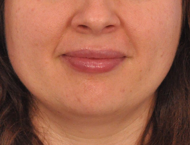 Lip Filler Before & After Gallery - Patient 296687 - Image 2