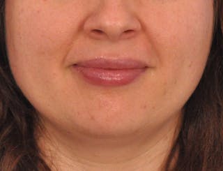 Lip Filler Before & After Gallery - Patient 296687 - Image 2