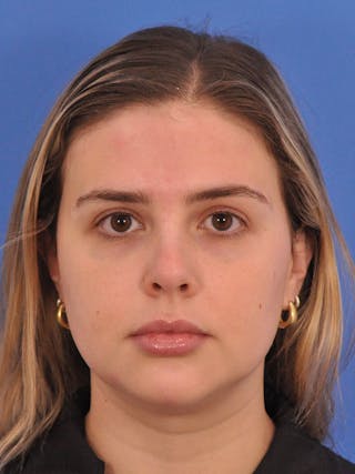 Chin Filler Before & After Gallery - Patient 170133 - Image 6