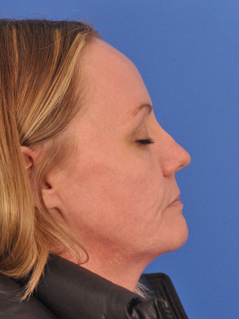 Acne Scars Before & After Gallery - Patient 147868 - Image 5