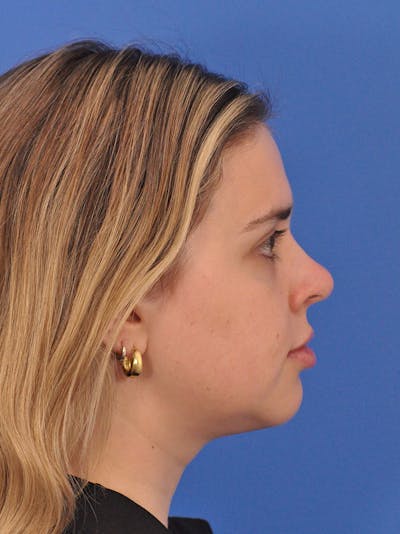 Chin Filler Before & After Gallery - Patient 170133 - Image 1