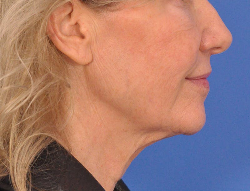 Profound Laser Before & After Gallery - Patient 312847 - Image 5