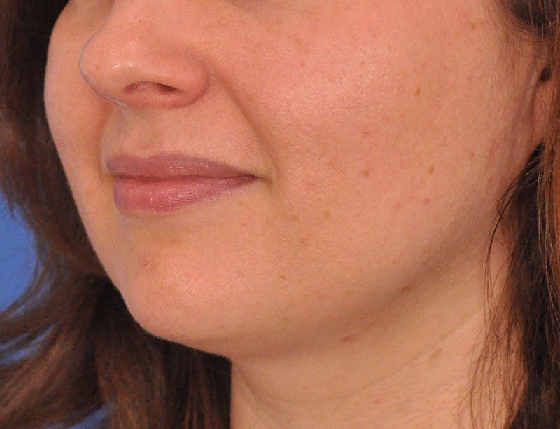 Lip Filler Before & After Gallery - Patient 296687 - Image 7