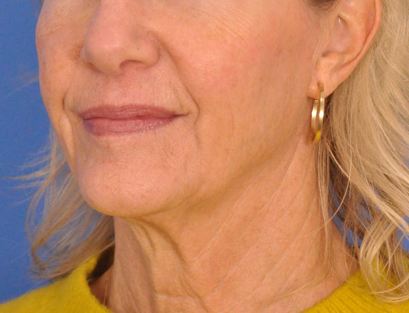 Profound Laser Before & After Gallery - Patient 312847 - Image 8