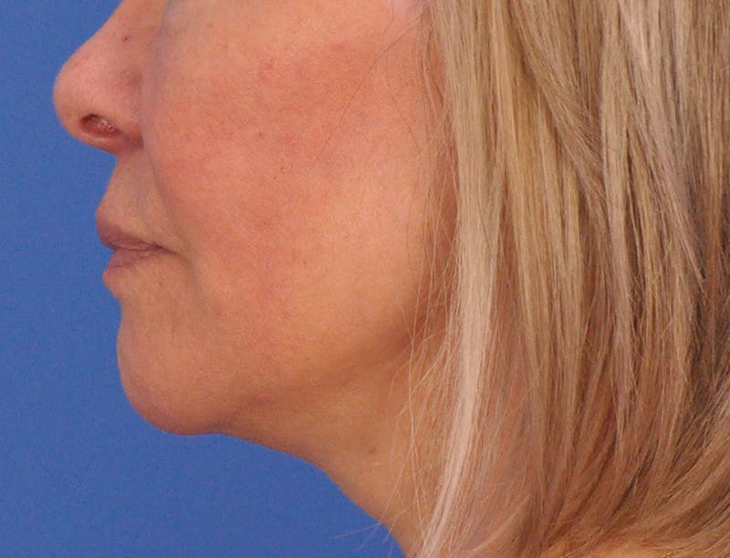 Lip Filler Before & After Gallery - Patient 325554 - Image 9