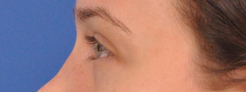 Tear Trough Filler Before & After Gallery - Patient 401813 - Image 9