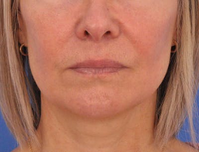 Lip Filler Before & After Gallery - Patient 325554 - Image 1