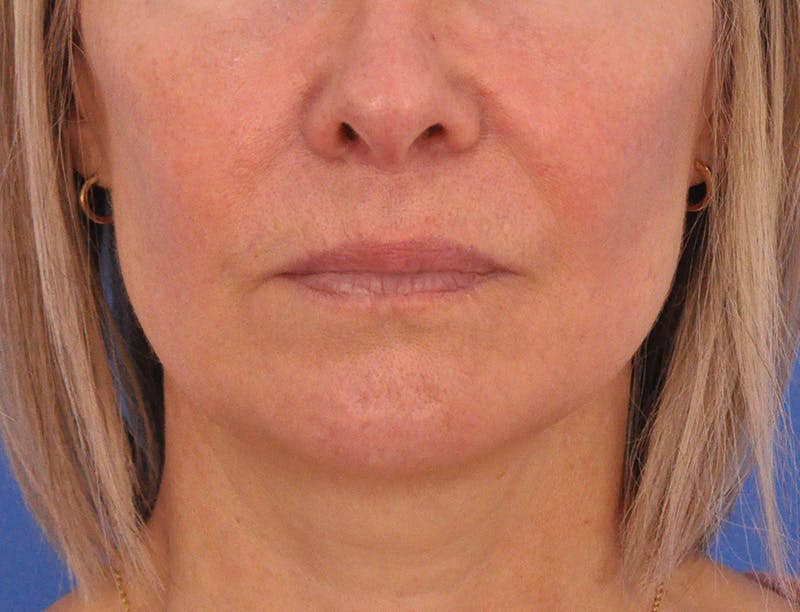 Lip Filler Before & After Gallery - Patient 325554 - Image 1